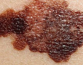cancer-de-pele:-como-identificar-se-pintas,-manchas-e-outros-sinais-podem-indicar-doenca